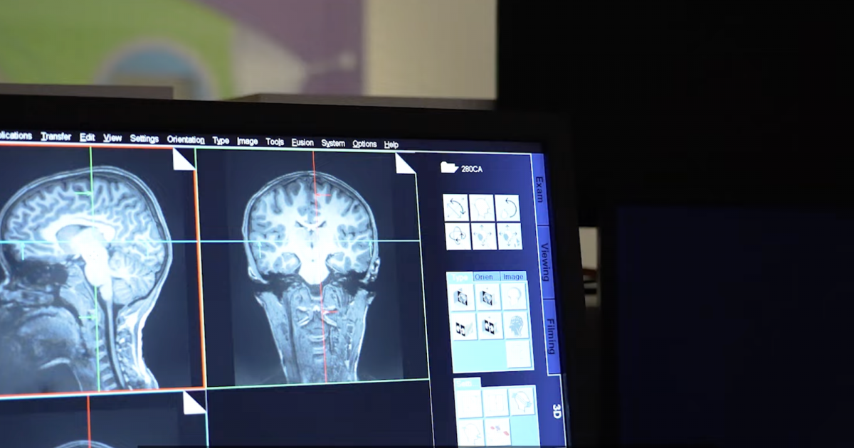 CRNL : une vidéo pour valoriser la recherche en neurosciences